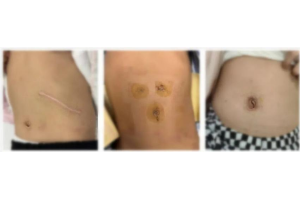 From a 20 cm Scar to a Hidden Incision—One Family's Journey Through Three Generations of Surgical Innovation