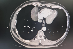 Central China's First Single-Port Robotic Resection of Mediastinal Tumor Completed